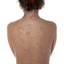 how to get rid of cystic acne kiyafet kombinleri sivilce izi dogal akne tedavisi akne tedavisi