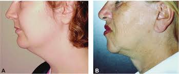 Deep Neck Lift: Defining Anatomical Problems and Choosing Appropriate  Treatment Strategies