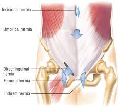 hernia repair guide drugs com