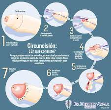 La Circuncision Urologo El Salvador Dr Herbert Ayala