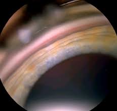 Image result for Gonioscopy