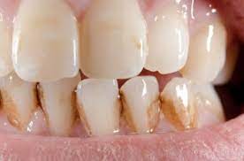Coffee stains are the more common cause for stains on teeth. How To Get Rid Of Coffee Stains Between Teeth