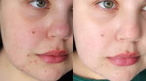 A treatment for severe nodular acne: Affordable Laser Treatment For Acne Scars Ipl Laser Before After Youtube