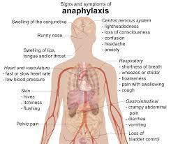 The early symptoms may be mild, such as a be prepared. Datei Signs And Symptoms Of Anaphylaxis Svg Wikipedia