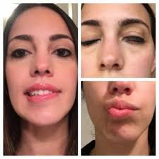 Bell's palsy causes weakness or paralysis of the muscles on one side of the face. Bell S Palsy Treatment Market Rising Demand With Leading