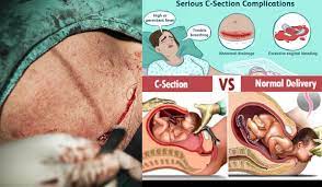 8 tips kurangkan sakit & sembuhkan luka bersalin dengan cepat via siraplimau.com. 8 Tips Kurangkan Sakit Sembuhkan Luka Bersalin Dengan Cepat