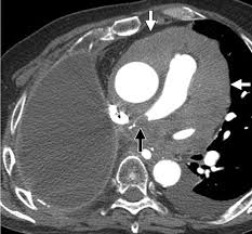 Maybe you would like to learn more about one of these? Multimodality Imaging For Characterization Classification And Staging Of Malignant Pleural Mesothelioma Radiographics