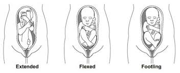 Image result for Breech Delivery