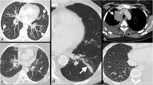 Therefore computer aided diagnosis can be helpful for doctors to identify the cancerous keyword: Imaging Diagnosis Of Metastatic Breast Cancer Insights Into Imaging Full Text