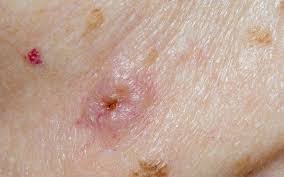 Infection rate on the rise in kids 2021, июль. What Is Mrsa