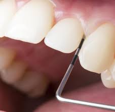 Karies Behandlung Zahnfaule Entfernen Ganz Ohne Bohren Welt