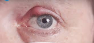 Untuk menghilangkannya, ada beberapa cara yang. Obat Bisul Di Kepala Archives Semua Bisa