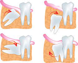 Wisdom teeth usually erupt between the ages 18 to 25, but can take years to fully emerge through the gums. What You Should Know About Wisdom Teeth Complications And Removal
