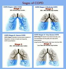 Stagesof Copd Respiratory Therapy Copd Stages