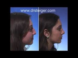 Rhinoplasty In A Teenager By Dr Jacob Steiger Steiger Facial Plastic Surgery Drsteiger Pr Rhinoplasty Facial Plastic Surgery Facial Plastic