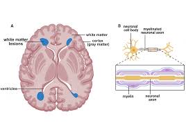 Image result for Brain Lesion