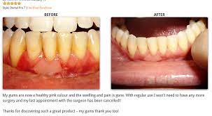 Periodontitis can't be reversed, only slowed down, while gingivitis can be reversed. Can Receding Gums Be Reversed Care Com