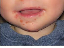 Coxsackievirus infection symptoms and signs include sore throat, rash, and blisters. Tiga Langkah Pencegahan Jangkitan Penyakit Kuku Tangan Dan Mulut Yang Wajib Ibu Bapa Tahu Berita Gps Bestari