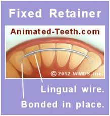 Replacement retainer cost varies per location and dental clinic. How Much Do Retainers Cost New Replacement Prices Diy Kits