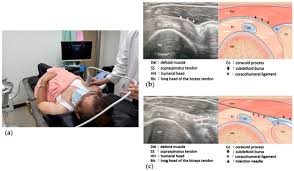 Image result for Subacromial Space Injection
