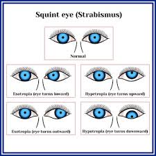 In the united states, approximately 1.2 million procedures are performed. Strabismus Photos Royalty Free Images Graphics Vectors Videos Adobe Stock