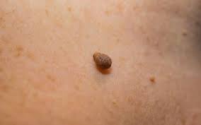 When to remove steri strips? How To Remove Steri Strips Safely After Surgery