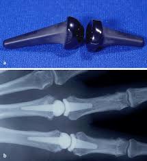 Dachte es ist nur aus silikon und lese hier das auch metall drin ist. Endoprothetik Des Fingergrundgelenks Springerlink