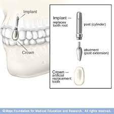 Superb Tooth Implant Before And After Dental Care Oralcareph Blackdentalhygienist Dental Implant Surgery Teeth Implants Dental Implants