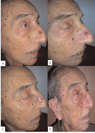 Nearly 90% of basal cell carcinomas occur on the face. A Preoperative Appearance Of Basal Cell Carcinoma On The Nose B Download Scientific Diagram