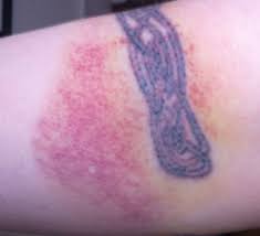 Aspirin is a blood thinner, so being on aspirin will make your tattoo bleed more. Swelling After Getting A New Tattoo Is It Normal Authoritytattoo