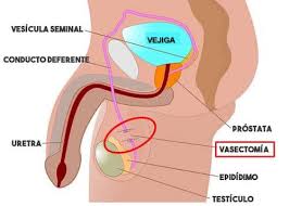 Vasectomy is a surgical procedure for male sterilization or permanent contraception. Vasectomia Sin Bisturi Mty Home Facebook