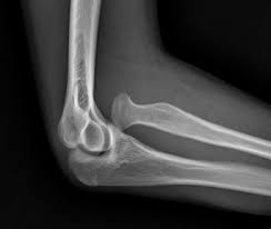 Image result for Radial Head Dislocation
