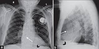 These are called demand pacemakers. Artificial Cardiac Pacemaker Wikipedia