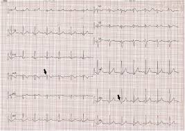 In about half of all patients with pericarditis, the heart rhythm goes through a sequence of four distinct patterns. Potentially Missed Acute Pericarditis Atypical Pericarditis The American Journal Of Emergency Medicine