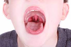 Should I Have My Tonsils Removed Dr Gan Eng Cern