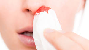 I don't usually get nosebleeds. Epistaxis Sangerare Nazala Simptome Cauze Tratament Prevenire Complicatii