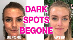 Totalbeautyadvisors.com has been visited by 10k+ users in the past month The Ultimate Dark Spot Remover Guide Youtube