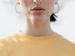 Structurally, its backbone is a basic steroidal nucleus with four rings. After 15 Years Of Cystic Acne This Drug Finally Cleared Up My Sk