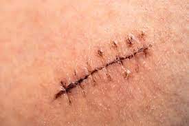 There are certain instances in which stitches may not be advised, such as puncture wounds, though you may still need to see a doctor, especially if you have not had a tetanus shot in more than five. Dissolvable Stitches How Long They Last Care Tips And Removal