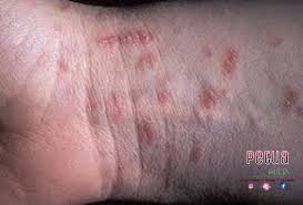 Mencari tahu lebih lengkap tentang. Petua Kita Penyakit Kulit Scabies Punca Kudis Buta Facebook