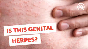 Image result for genital herpes