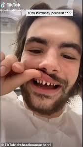 The kid laroi's snl debut a 'massive moment' for local hiphop. Dentists Urge Social Media Users Not To Embrace Trend That Involves Shaving Teeth To Pegs Daily Mail Online