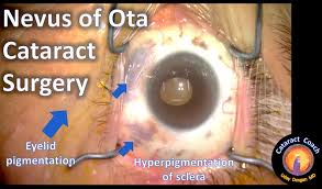 Image result for nevus sclerae