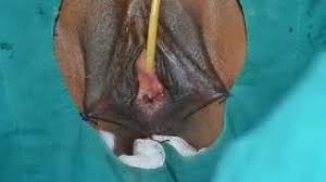 Agenesis of wisdom teeth is a normal condition that can differ widely by population, ranging from practically zero in tasmanian aborigines to nearly 100% in indigenous mexicans. Mullerian Agenesis Congenital Absence Of Vagina Uterus Vaginoplasty Youtube