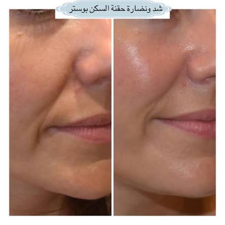 ما هي حقن Skin Booster للبشرة وأهم فوائدها❓ حقن "سكن بوستر" Skin Booster وتسمى كذلك بحقن النضارة في عالم التجميل، هي عبارة عن حقن "فيلر" يتم استخدام فيها منتج الـ " Light
