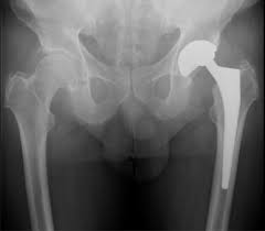 Polyethylene Liner Dissociation With The Pinnacle Acetabular Component Should We Be Concerned Sciencedirect
