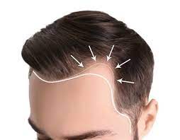 And, luckily enough, all this research has given us some great treatments. What Causes Uneven Hairline Can It Be Fixed