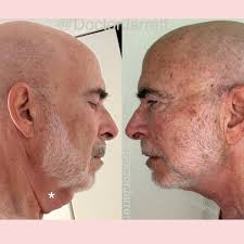 Neck Lift & Décolleté
