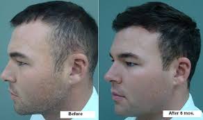 Gayarambut botak bagian depan rambut yang tumbuh lebat di bagian belakang kepala, juga sering dialami oleh sebagian pria. Lelaki Dan Rambut Rontok Apakah Pilihan Kesihatan Lelaki 2021