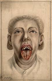 Syphilis has been on the rise in males, especially homosexuals, compared to females where it has shown a decline. The Victorian Prostitute Whose Pox Inspired Feminists Brewminate